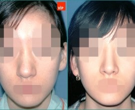 Septal cartilage rhinoplasty