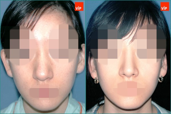 Nose Surgery - Septal cartilage rhinoplasty