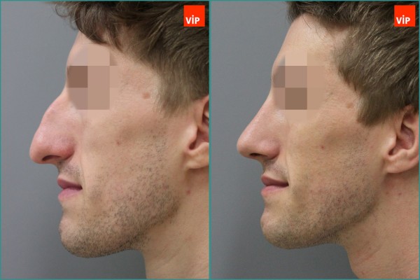 Nose Surgery - Septal cartilage rhinoplasty, Hump nose Surgery