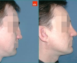 Hump Nose Septal cartilage rhinoplasty, Mid Face Augmentatio…