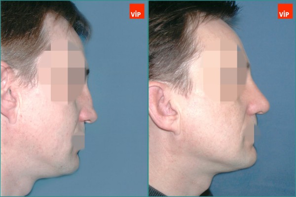 Nose Surgery - Hump Nose Septal cartilage rhinoplasty, Mid Face Augmentation