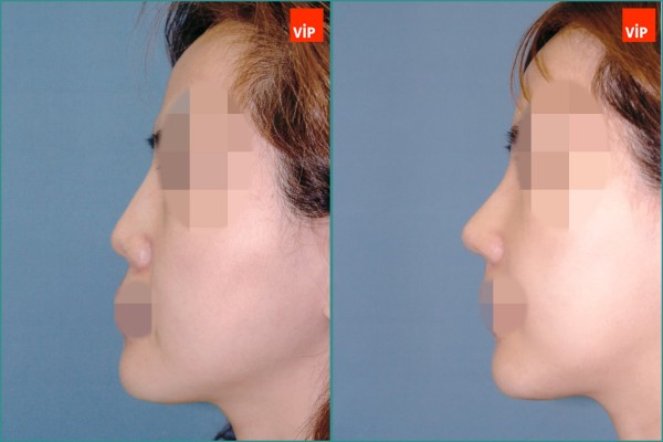 Nose Surgery - Septal cartilage rhinoplasty