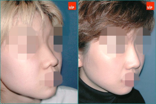 Nose Surgery - Septal cartilage rhinoplasty