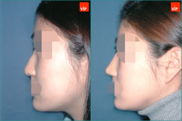 Nose Surgery - Septal cartilage rhinoplasty