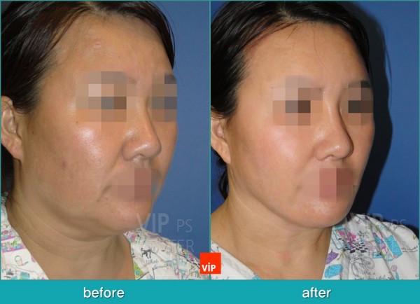 Face Lift - High SMAS Face / Necklift