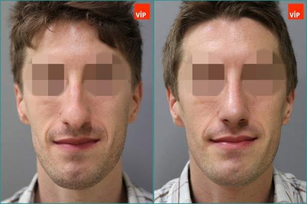 Nose Surgery - Septal cartilage rhinoplasty, Hump nose Surgery