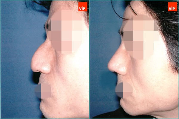 Nose Surgery - Hump nose