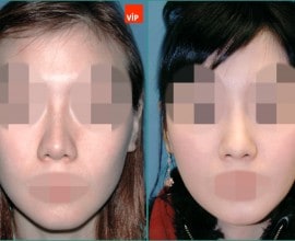 Septal cartilage rhinoplasty