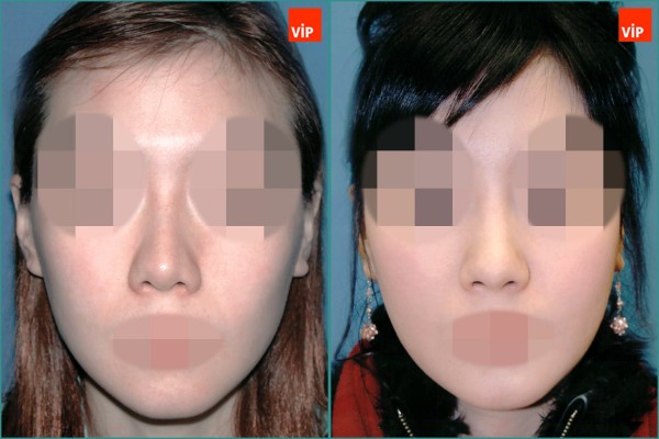 Nose Surgery - Septal cartilage rhinoplasty