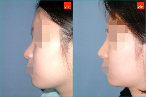 Nose Surgery - Septal cartilage rhinoplasty