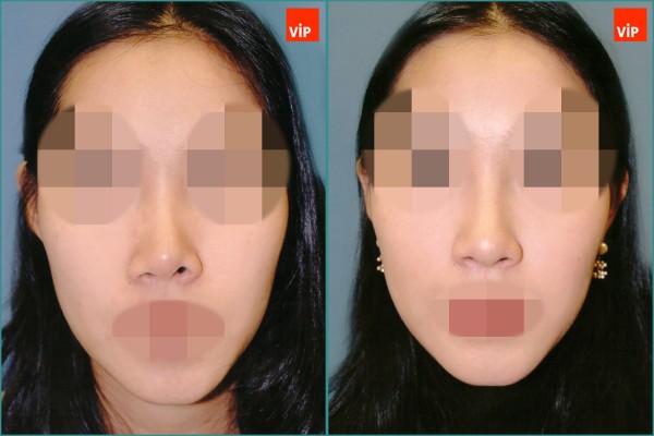 Nose Surgery - Septal cartilage rhinoplasty