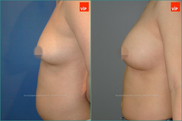 Breast Surgery - Breast Surgery