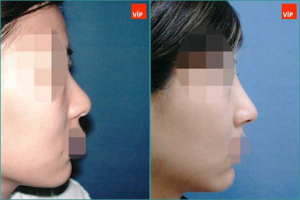 Nose Surgery - Septal cartilage rhinoplasty