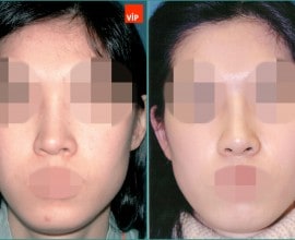 Septal cartilage rhinoplasty