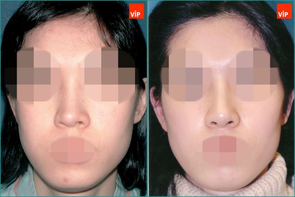 Nose Surgery - Septal cartilage rhinoplasty