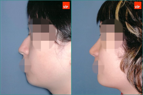 Nose Surgery - Hump nose