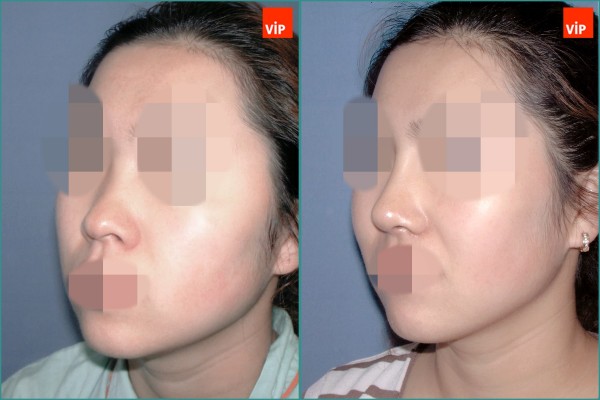 Nose Surgery - Septal cartilage rhinoplasty