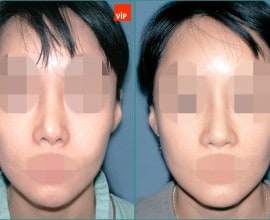 Rib cartilage rhinoplasty