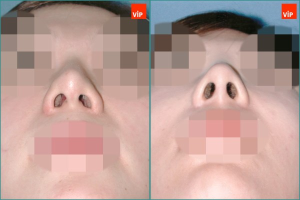 Nose Surgery - Septal cartilage rhinoplasty