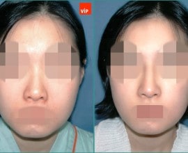 Rib cartilage rhinoplasty