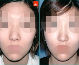 Septal cartilage rhinoplasty