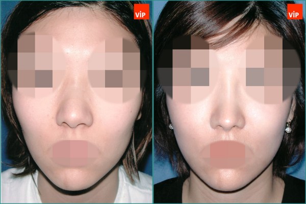 Nose Surgery - Septal cartilage rhinoplasty