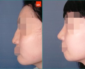Hump Nose Septal cartilage rhinoplasty