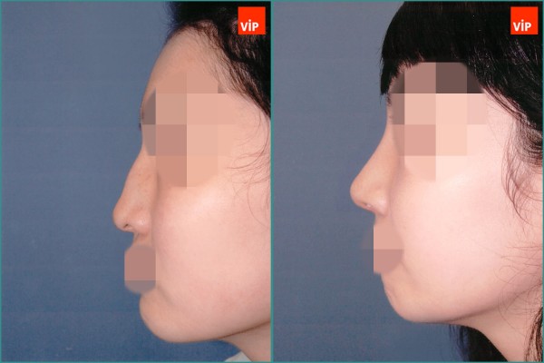 Nose Surgery - Hump Nose Septal cartilage rhinoplasty