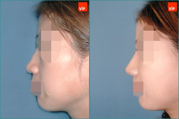 Nose Surgery - Septal cartilage rhinoplasty