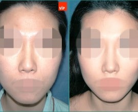 Septal cartilage rhinoplasty