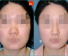 Septal cartilage rhinoplasty