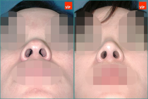 Nose Surgery - Septal cartilage rhinoplasty