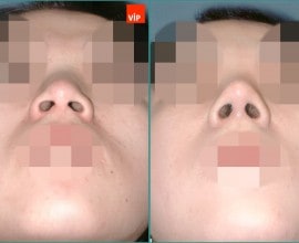 Septal cartilage rhinoplasty