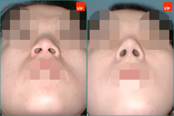 Nose Surgery - Septal cartilage rhinoplasty