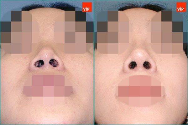 Nose Surgery - Septal cartilage rhinoplasty