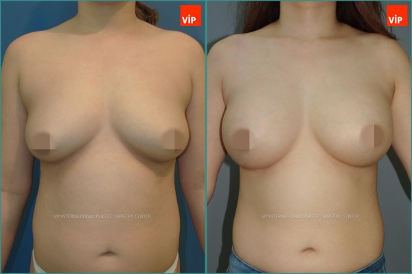 Breast Surgery - Breast Surgery