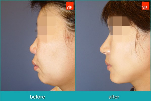 	Nose Surgery, Rib cartilage Rhinoplasty, Facial Bone Surgery, Stem Cell Fat Graft	 - Rib Cartilage Rhinoplasty, Face Contouring Surgery, V-line Surgery, Fat Graft, Cheekbone Reduction