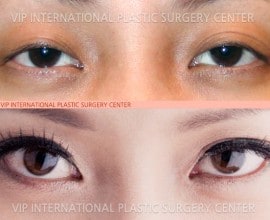 Ptosis correction