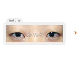 Incision double eyelid surgery