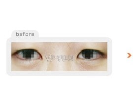 Incision double eyelid surgery