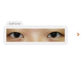 Non-incision double eyelid surgery