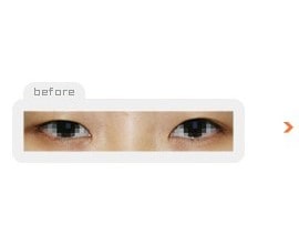 Non-incision double eyelid surgery