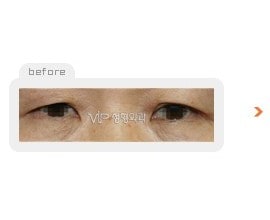 Upper & Lower blepharoplasty