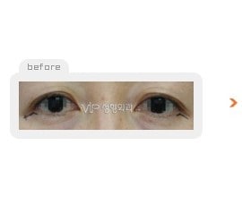 Upper & Lower blepharoplasty