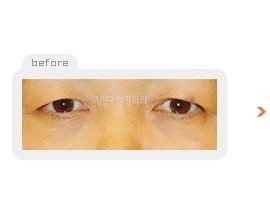 Upper & Lower blepharoplasty