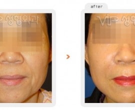 Wrinkle improvement surgery