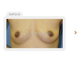 Breast augmentation