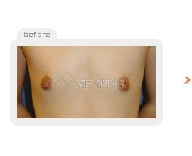 Breast augmentation