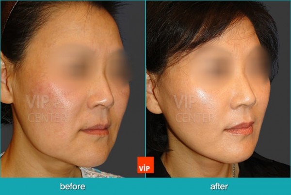 	Face Lift	 - High SMAS Face / Necklift