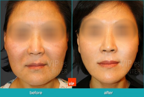 	Face Lift	 - High SMAS Face / Necklift